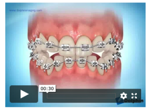 Port d'élastiques verticaux
