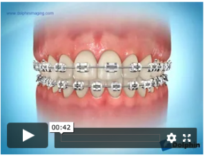 Elastiques asymétriques