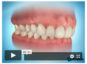 Plaque de surélévation