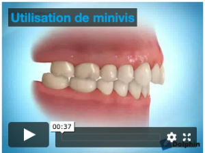 Utilisation de minivis