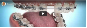 Traitement d’agénésie des incisives latérales par fermeture des espaces