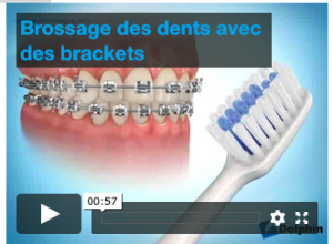 Brossage des dents avec des brackets