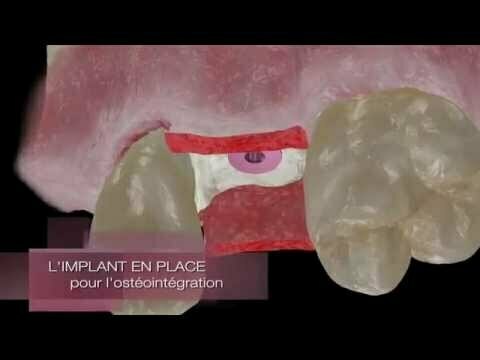 Pose d'implant dentaire