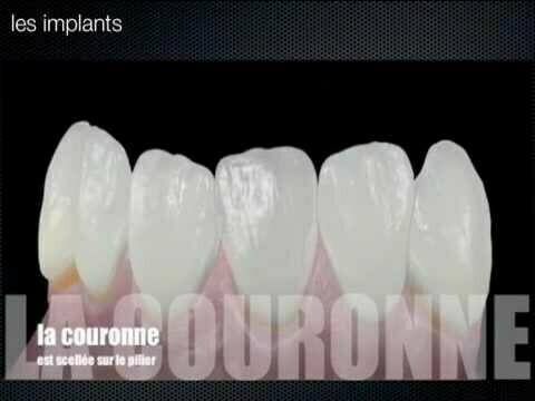 Prothèse implant dentaire