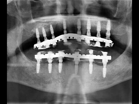 Chirurgie Dr Lambert MCI bimaxillaire en 2h30