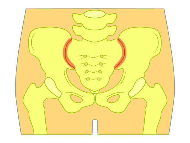 Syndrome sacroiliaque AFC Association Française de Chiropraxie Syndrome sacroiliaque AFC Association Française de Chiropraxie