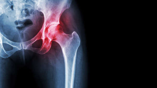 Exercices pour les douleurs de hanche | Blog