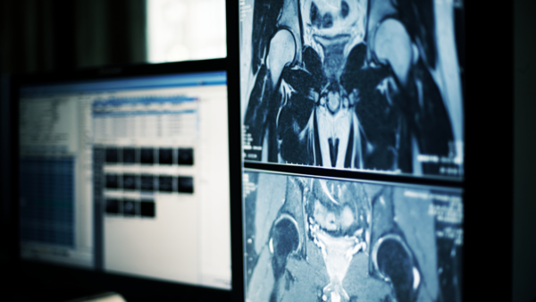 Lombalgie : l'imagerie diagnostique ne présente pas d'intérêt scientifiquement évalué 