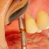 Insertion implant dentaire