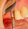 Insertion implant dentaire