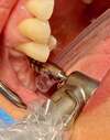 Préparation du site à implanter avec un tissue punch shaver