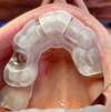 Guide chirurgical de l'implant