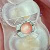 Préparation implant