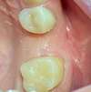 Espace dentaire pour implant