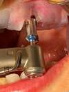 Pose implant dentaire