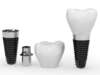 Les implants dentaires, un traitement fiable