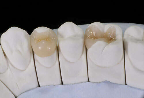 Les inlays et les onlays : une alternative au plombage