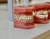 Modèles de dents équipés de bagues orthodontiques