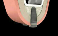 La greffe osseuse intra sinusienne ou sinus lift