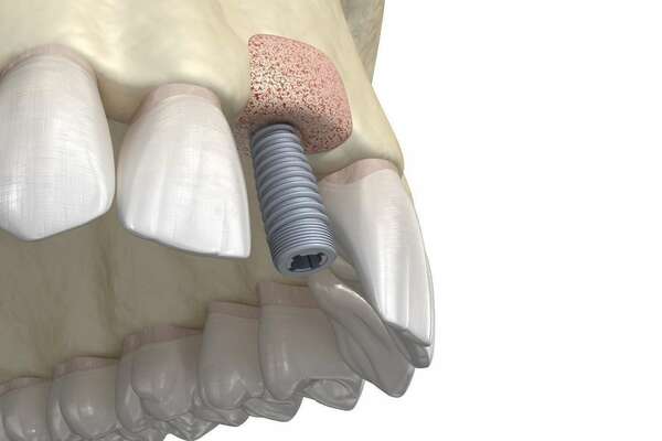 Les greffes osseuses pré-implantaires