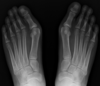 radio hallux valgus
