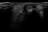 echographie tenosynovite de de Quervain