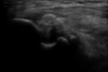 echographie golf elbow epicondylite médial