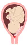 placenta praevia partiel