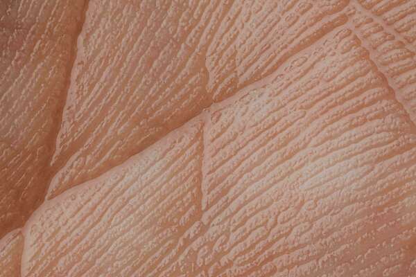 syndrome d'ehlers danlos osteo