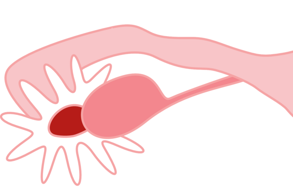 SOPK syndrome des ovaires polykystiques et ostéopathe Versailles