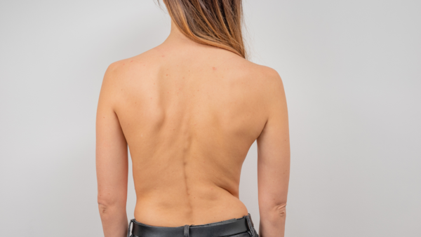 scoliose osteopathe versailles