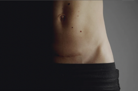 cicatrice césarienne douleur tecartherapie