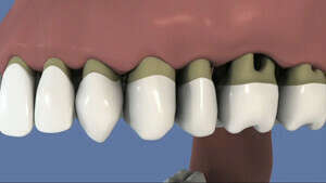 Brossette interdentaire et parodontite